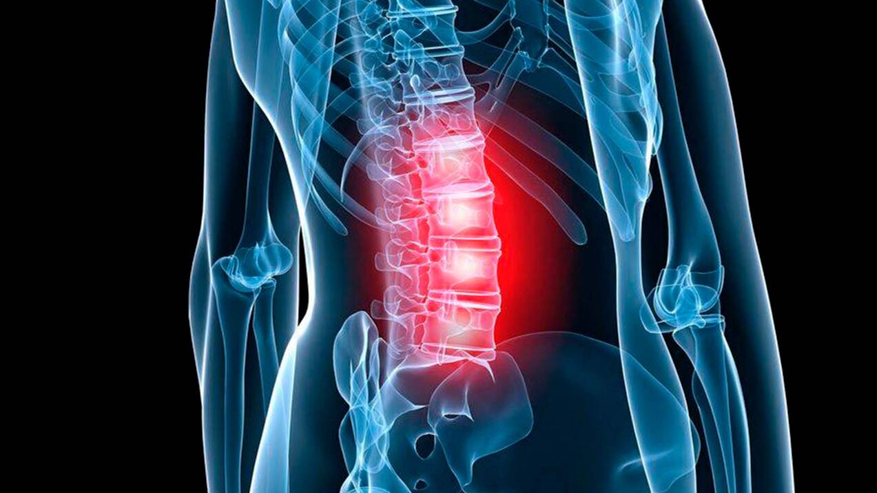 Síntomas da osteocondrose lumbar