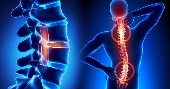 Localización da dor na osteocondrose