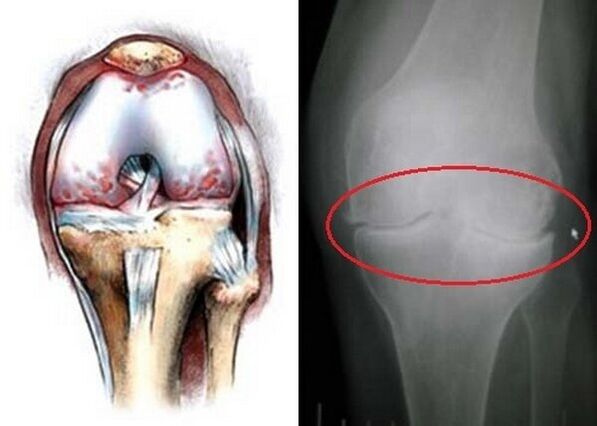 Osteoartrite da articulación do xeonllo