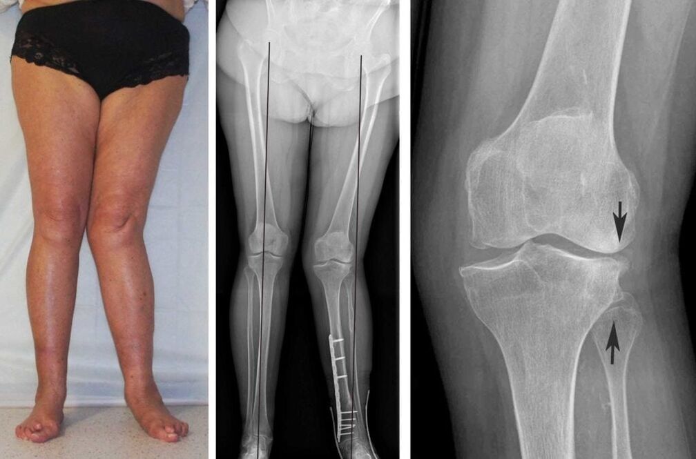 A osteoartrite avanzada das articulacións do xeonllo pódese ver claramente visualmente mesmo sen unha radiografía
